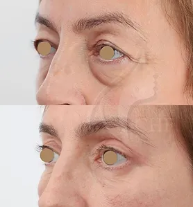 clinicachf_lifting-palpebras_01