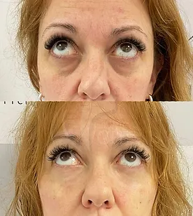 clinicachf_olheiras