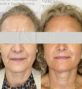 clinicachf_skinboosters_01