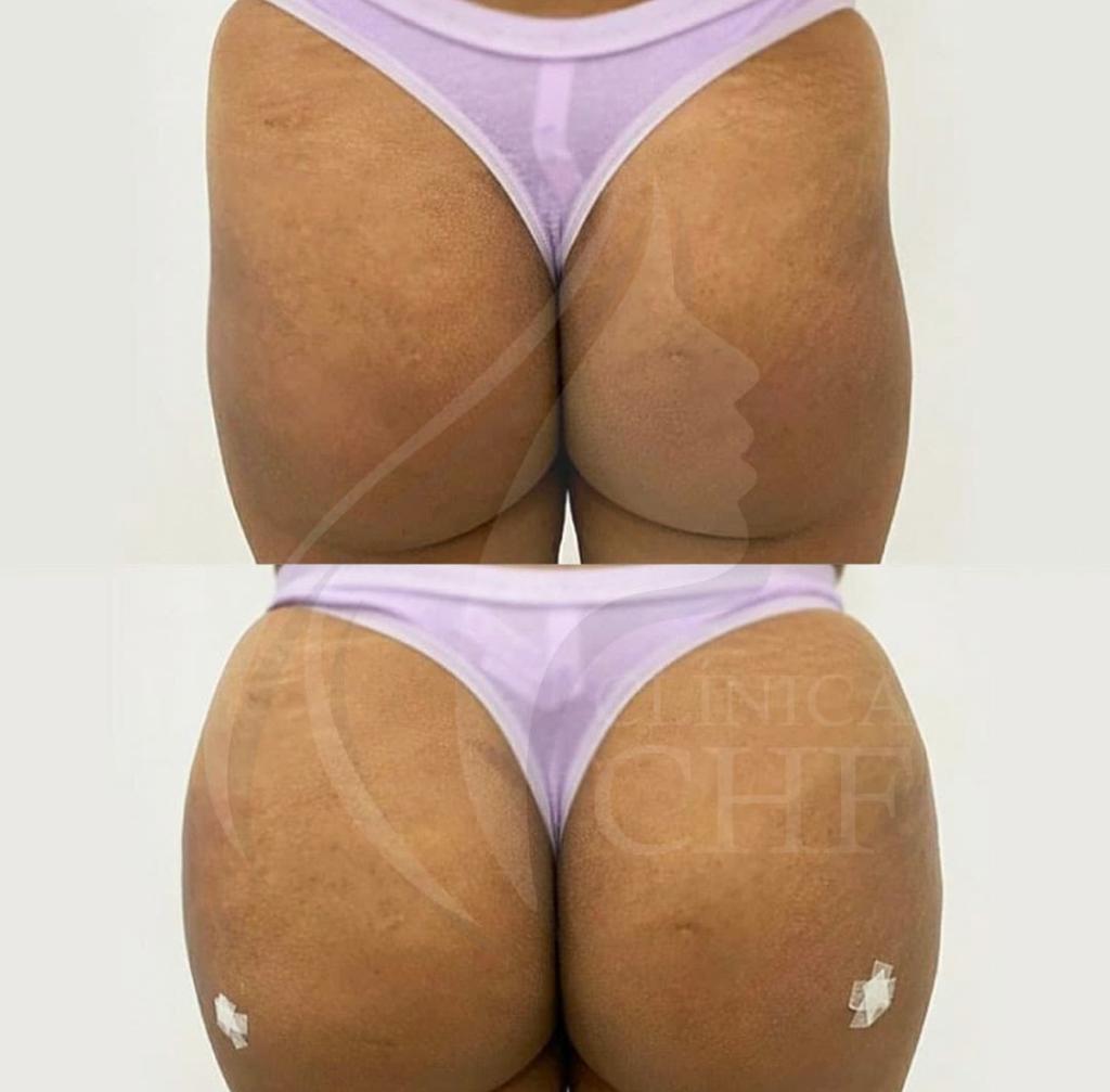 ANTES E DEPOIS
