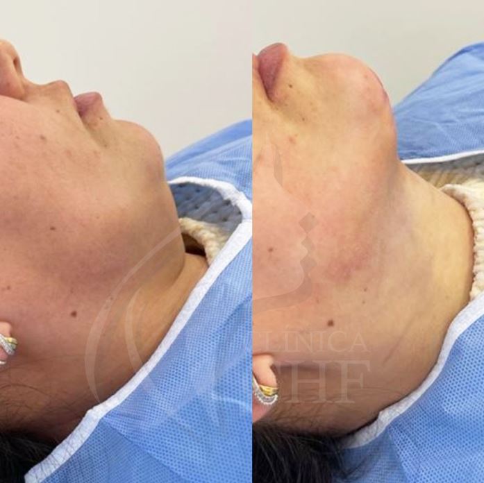 ANTES E DEPOIS