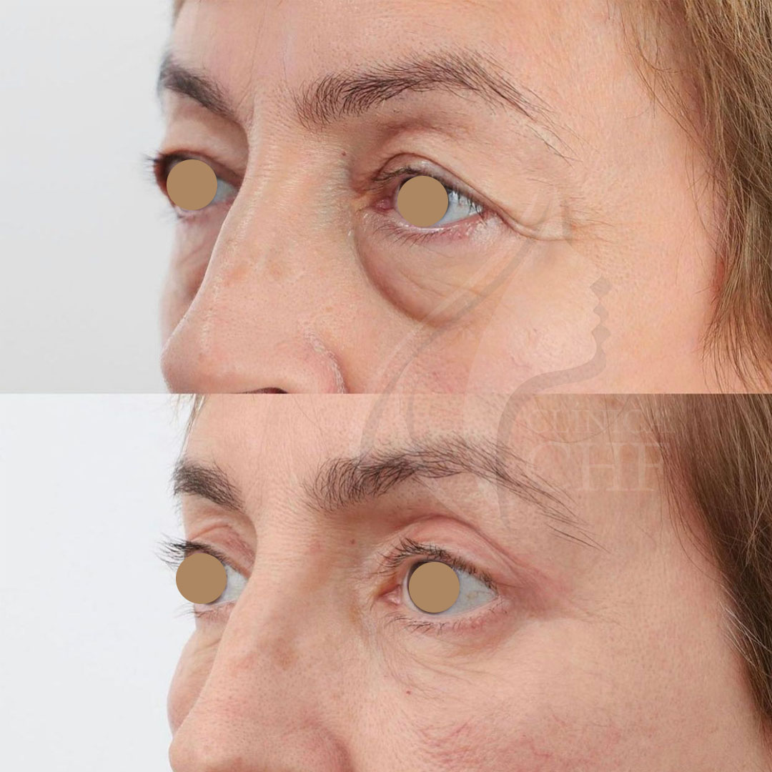 Blefaroplastiaaa