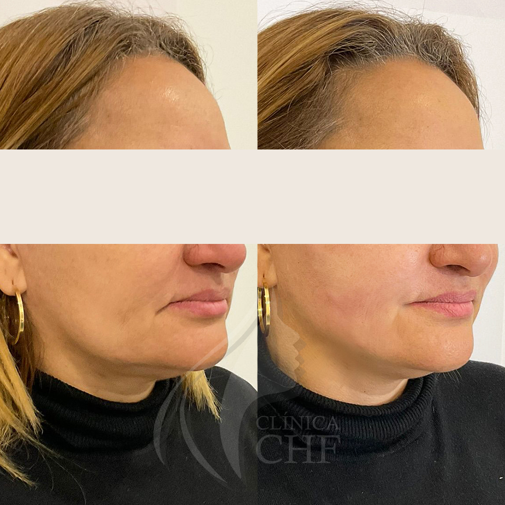 FIOS ANTES E DEPOIS