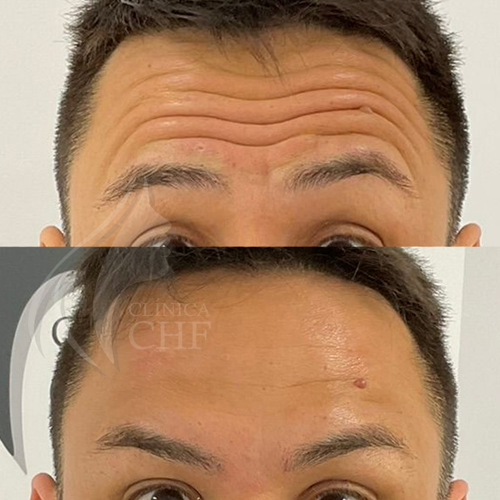 botox