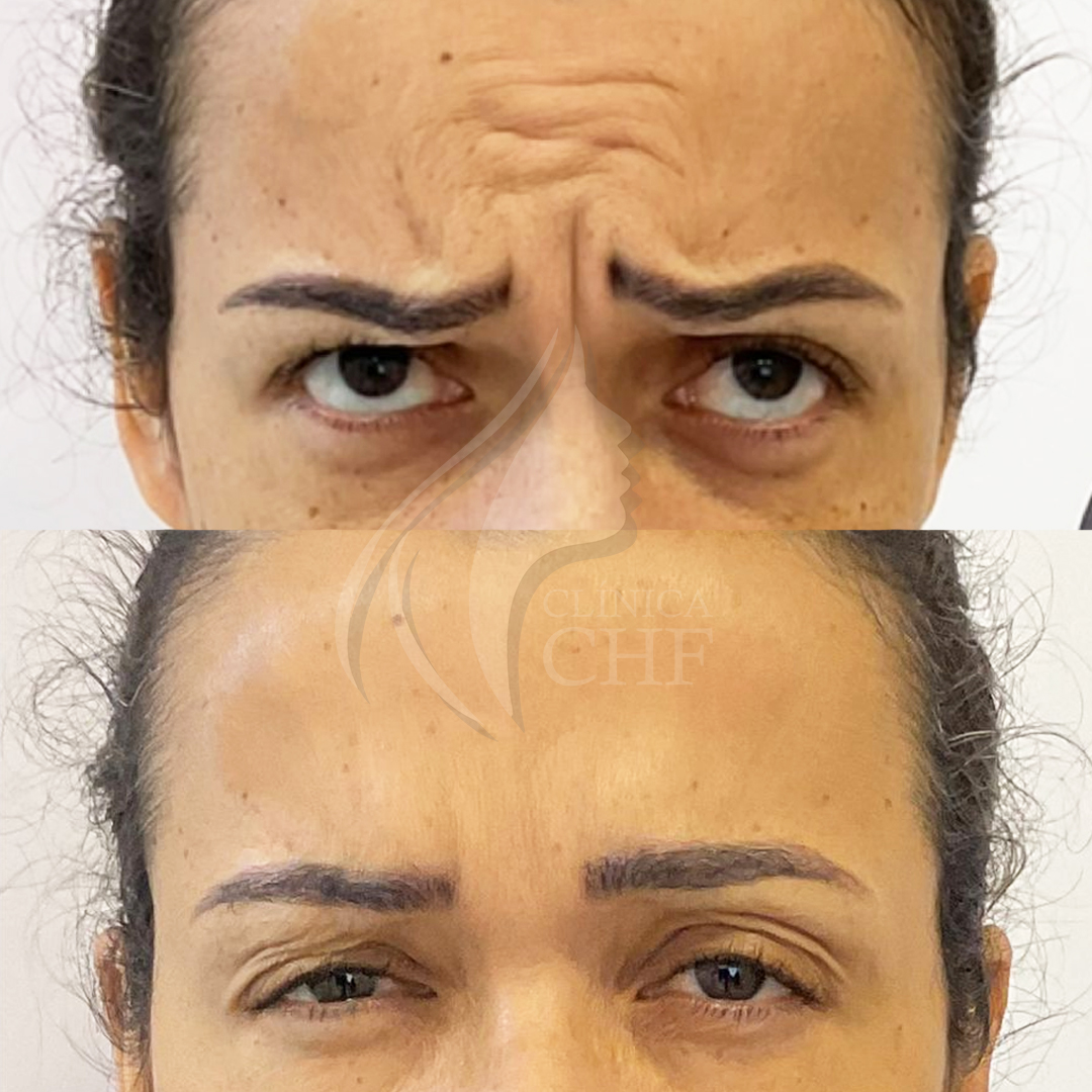 Botox