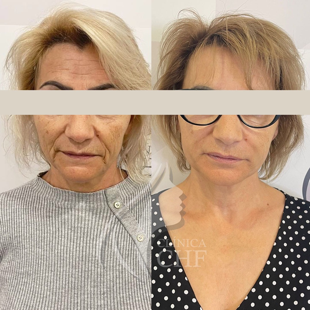 Preenchimento de Glúteos Resultado do Preenchimento de Glúteos