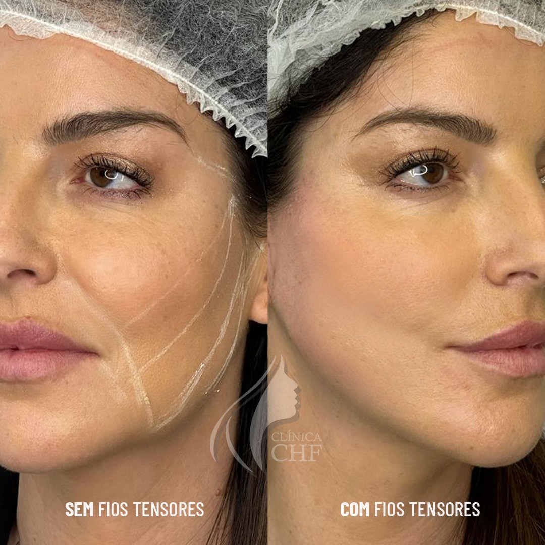 Preenchimento de Glúteos Resultado do Preenchimento de Glúteos