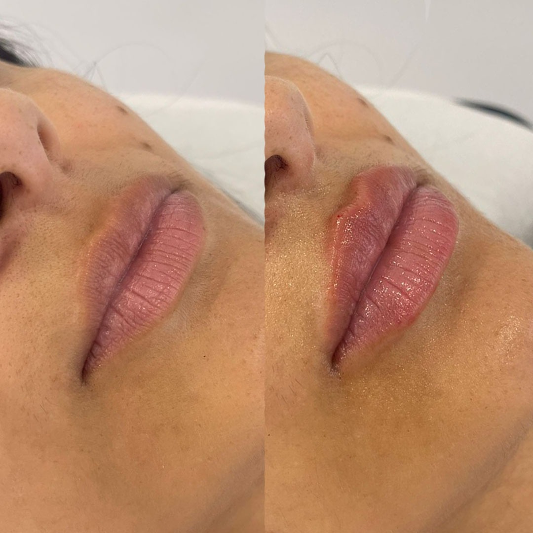 Preenchimento de Glúteos Resultado do Preenchimento de Glúteos